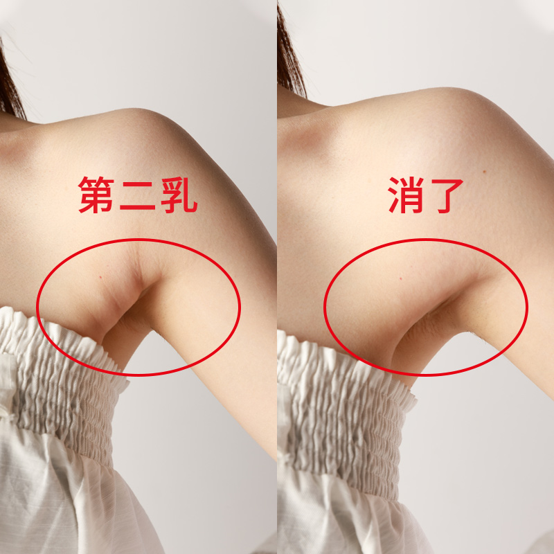 副乳上长乳头怎么办图片