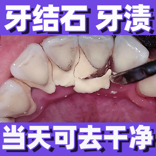 清除牙垢牙渍去除溶解牙结石神器洗牙器洁牙仪清除牙齿污垢除牙石