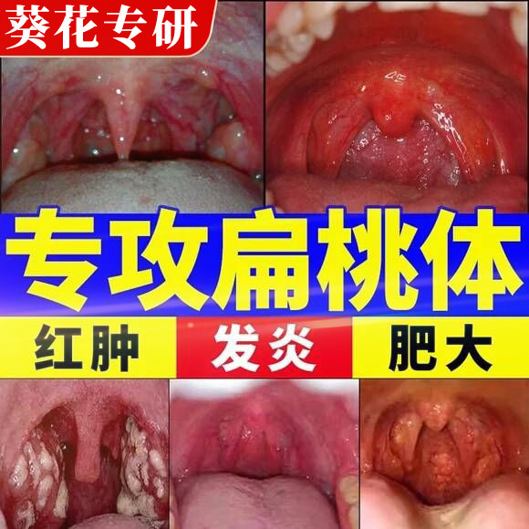 扁桃体发炎药咽喉咙肿痛结石儿童扁桃体肥大肿大贴有痰异物感神器