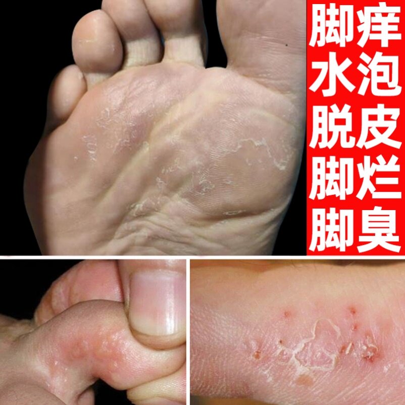 00淘宝新品治癣药膏手部烂脚丫的药膏贵州苗家药膏脚痒药膏泡脚预防