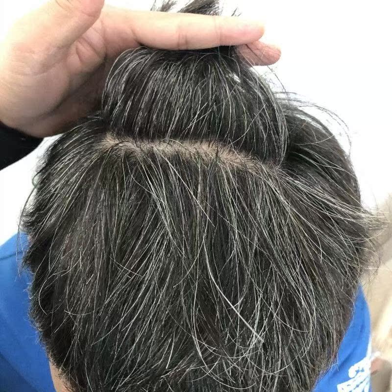 治疗白头发_白发变黑发治根头发变黑转黑乌发液治疗白发克星瑶方纯