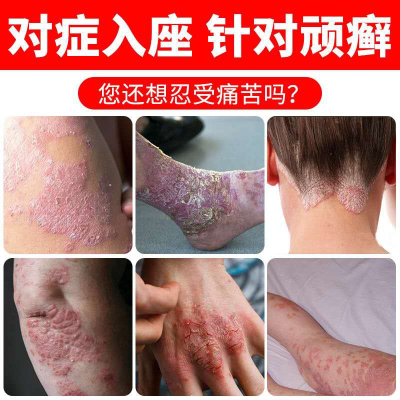 牛皮癣顽固银屑病老偏方脚藓慢性神经性皮炎去根除外用中药y膏断