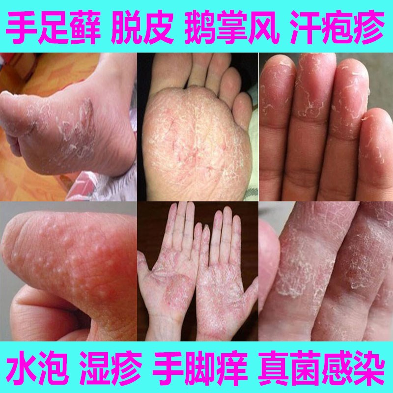 手癣脚癣花斑体癣手足癣药膏手气干裂脱n皮真菌感染脚藓手痒鹅掌
