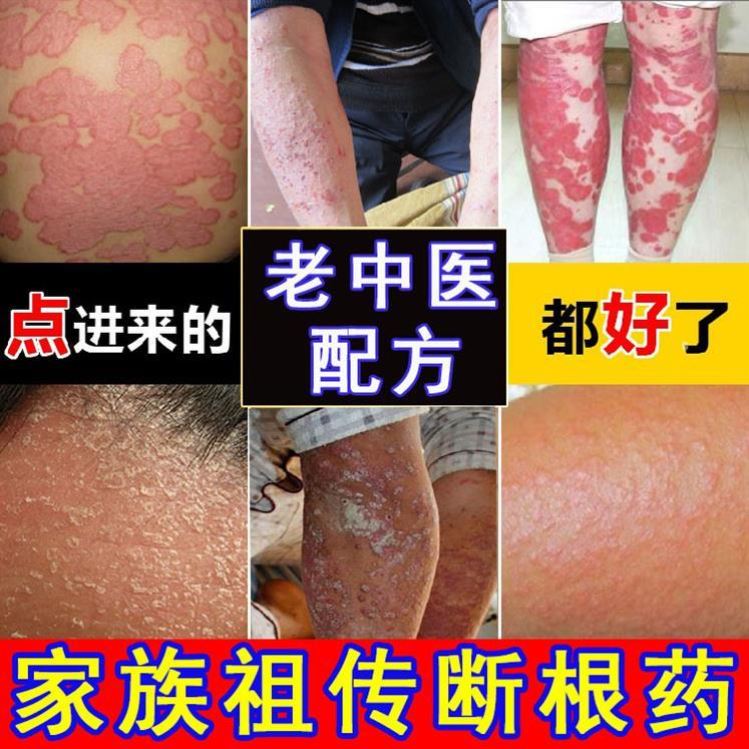 荨麻疹专用去头藓头痒洗发水皮炎药膏外用瘙痒银癣1迪治足藓 淘宝 份