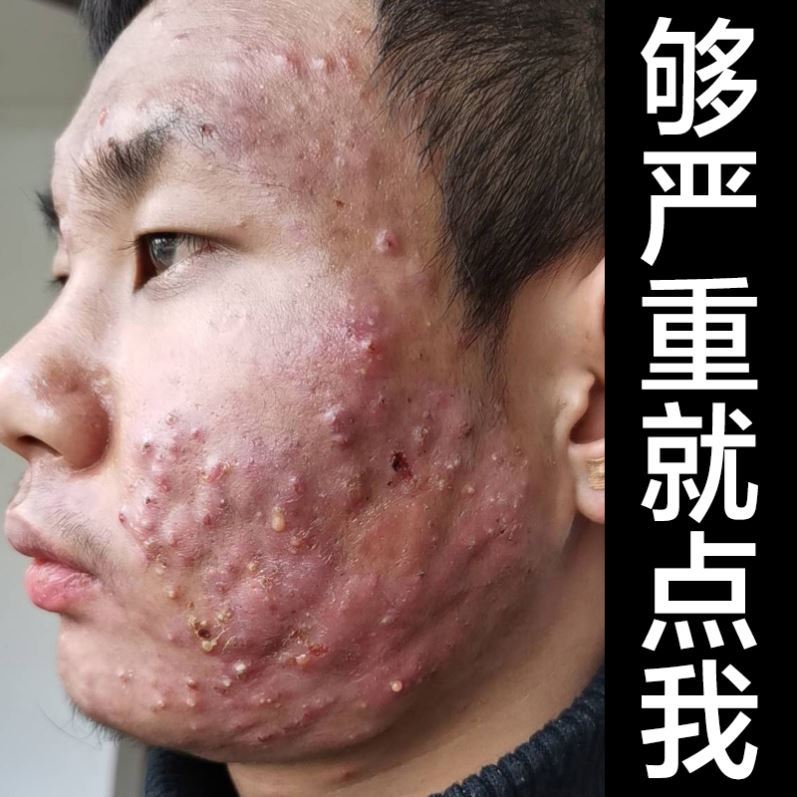 痤疮膏祛痘重度脸部脓脸部疱后背祛痘印痘坑修复淡化痘印男女神器