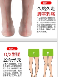 日本扁平足矫正鞋垫足弓垫纠正平底足底内翻支撑XO型腿足矫形器