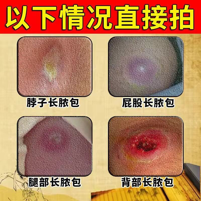 治火疖子拔毒拔脓膏神器屁股c硬块红肿火疖子拔脓膏贴火疖子药膏