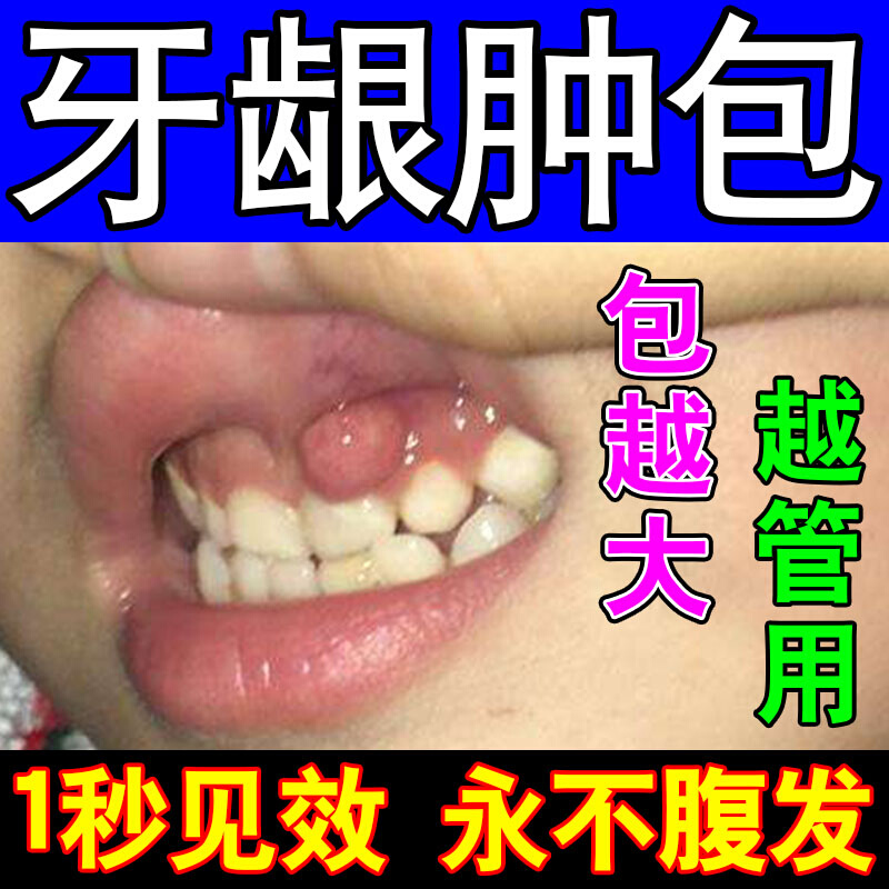 牙龈肿包消脓鼓包牙疼消焱牙龈肿痛止疼药速效保护剂瘘管上火g出