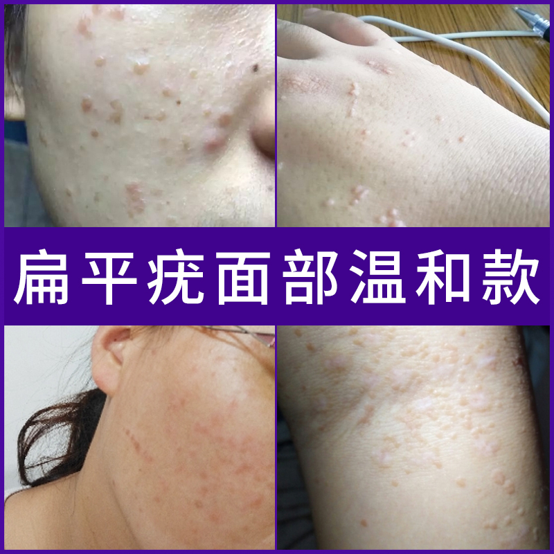 扁平疣日本去除膏正品去疣灵病毒疣面部面部一抹灵日本仪器去疣灵