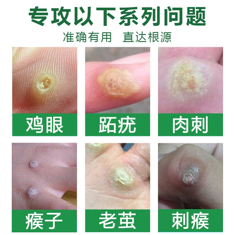 手上去鸡眼瘊子肉刺猴子祛除g神器治疗祛刺猴子肉粒疙瘩的药疣脚