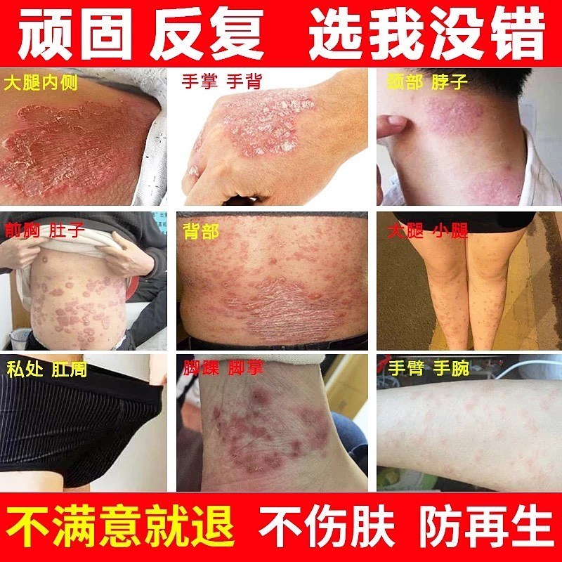 一折维生素a软膏_男人下面蛋蛋皮j肤痒维生素a乳膏去鸡皮复方利卡多因