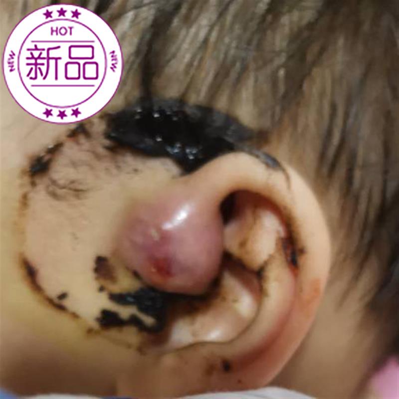 正宗封口清脓无痛异味流液耳前流脓鼓包肿炎护膝