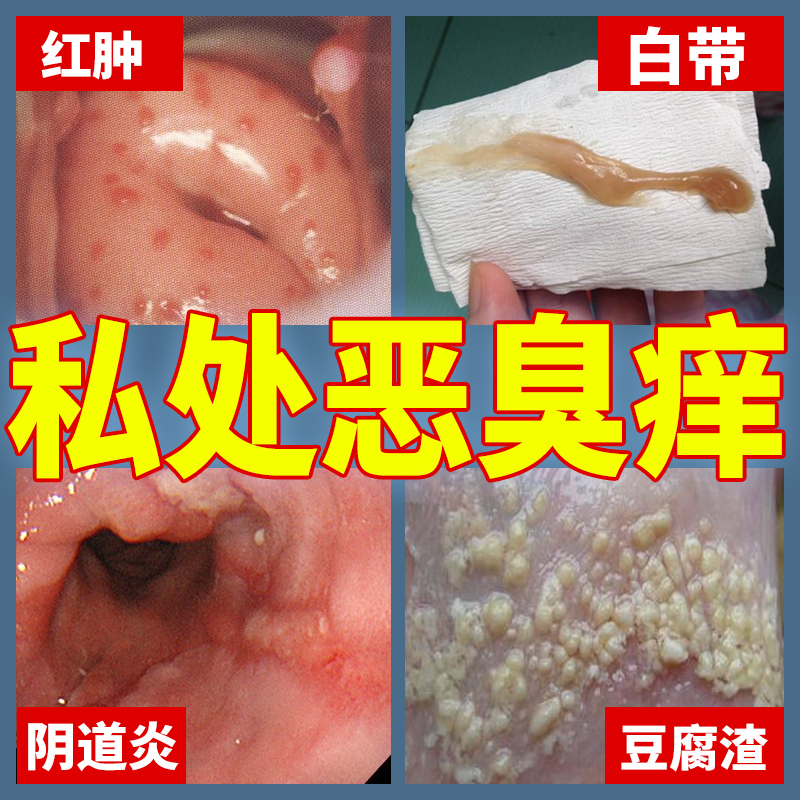 霉菌豆腐渣护理阴道用药念珠止痒抑菌私处凝胶私处保养