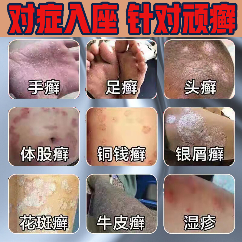 牛皮癣银屑病湿疹皮肤病治疗止痒去k根手足股藓外用癣藓特效药膏