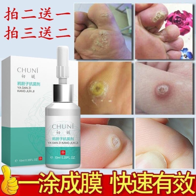 跖疣去除_去跖疣鸡眼瘊子扁平疣寻常疣刺猴膏净药去除足部脚底手部