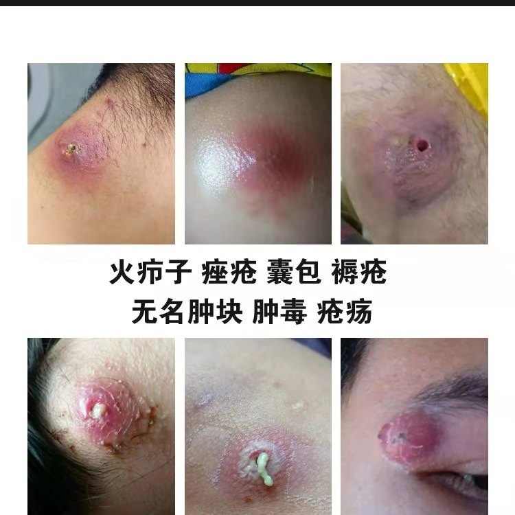 治火疖子拔毒拔脓膏神器屁股c硬块红肿火疖子拔脓膏贴火疖子药膏