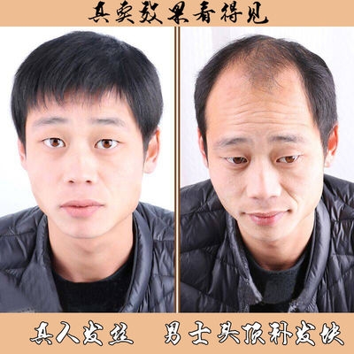 (今日9.5折)男士头顶假发男补发块寸头短发地中海秃顶真发遮盖白发透