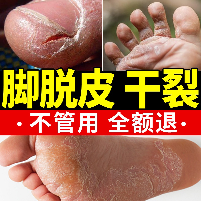 热销脱皮膏 去死皮_脚后跟干燥脱皮粗糙膏皮肤脚底干裂脚裂起皮不去