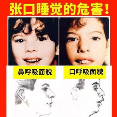 封嘴贴睡眠儿童嘴型呼吸矫正器张嘴睡觉封口贴粘嘴贴防张嘴通用贴