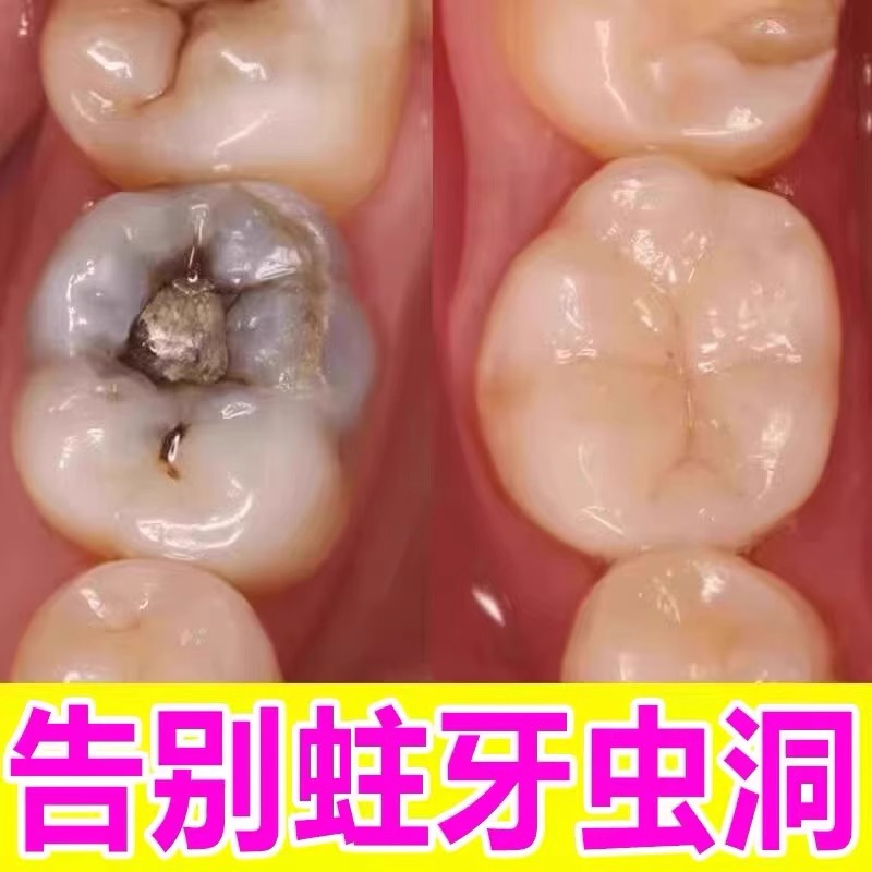 防蛀牙虫洞牙齿黑窟窿防蛀牙牙洞坏牙