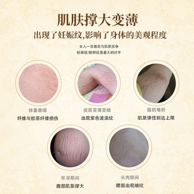 肥胖纹修复价格