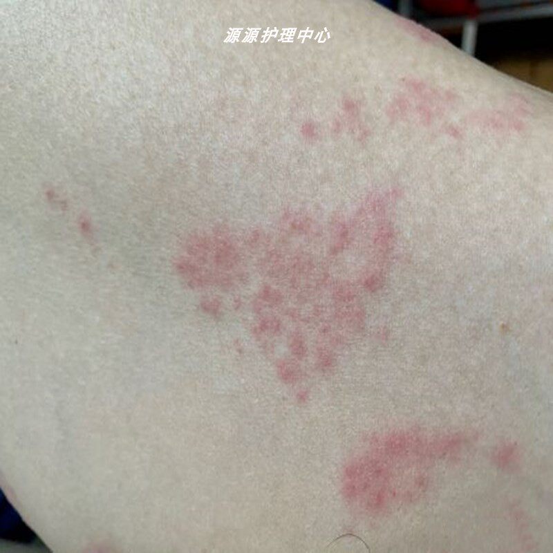 源源护理中心的优惠券大全—芙友敏癣净药膏汗疱疹鹅掌风手脚季节性