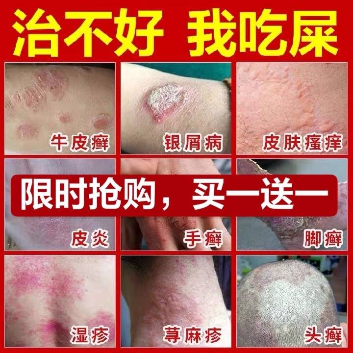 外用牛皮癣银屑病皮炎皮肤瘙痒药膏特效止痒断根专用紫椒癣酊根治