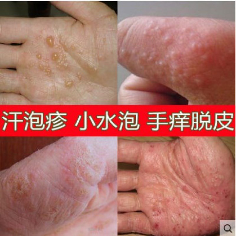 仁和汗泡疹膏手上起小水泡长痒手痒非汗状疱疹专用软膏汗孢疹非药