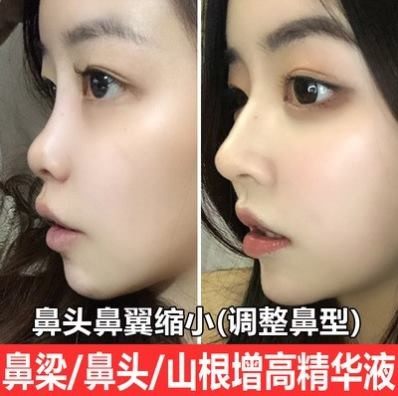 美鼻神器收缩小鼻翼神器丰高鼻梁山根精华液蒜头鼻塌鼻子精油