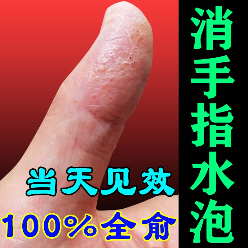 汗疱灵汗疱疹膏皮肤瘙痒脱皮手痒小水t泡手足癣真菌感染湿疹止痒