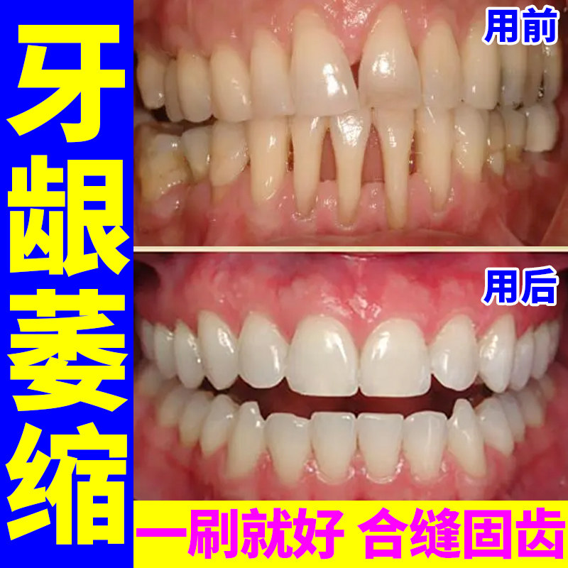 牙龈萎缩修复再生齿松动肿痛出血健龈固齿散牙粉牙缝宽大修复神器