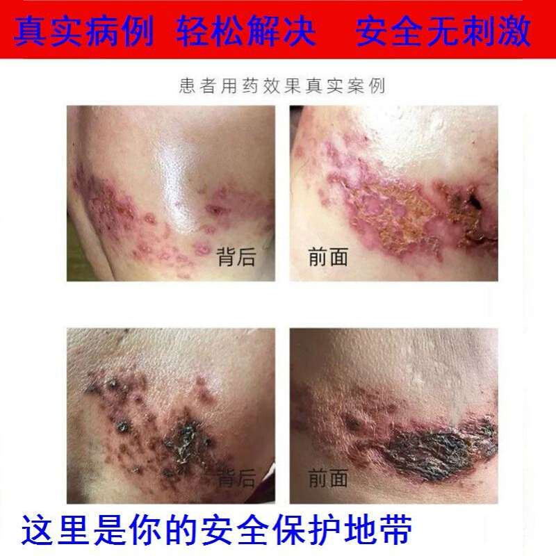 1券后价0人已购买券10元淘宝治疗梅毒淋病性病一扫光男女性私处流脓