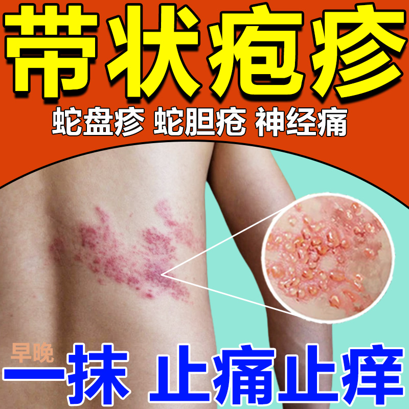 蛇盘疮带状疱疹后遗症神经痛喷剂蛇胆疮蛇缠腰止痒止疼外用药膏