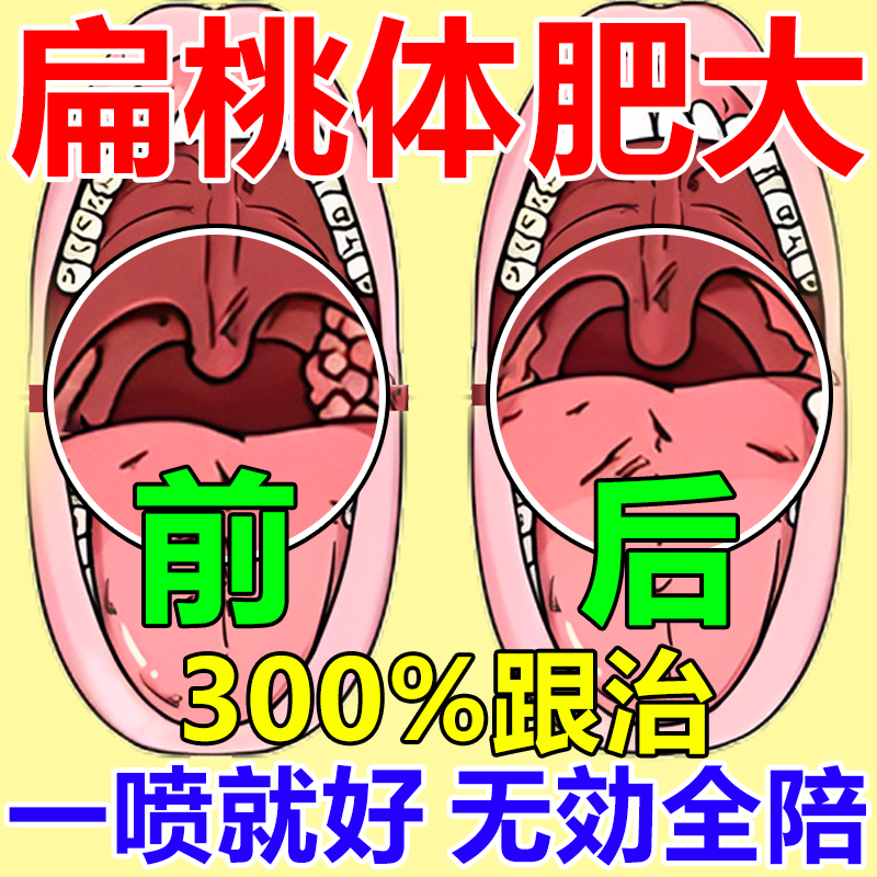 扁桃体肥大肿大贴治疗儿童打呼噜咽喉肿痛发炎张口呼吸不适咽扁贴