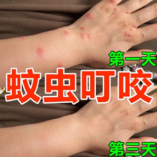 蚊虫叮咬快速止痒消肿婴儿宝宝儿童臭虫跳蚤叮咬止痒驱蚊膏日本