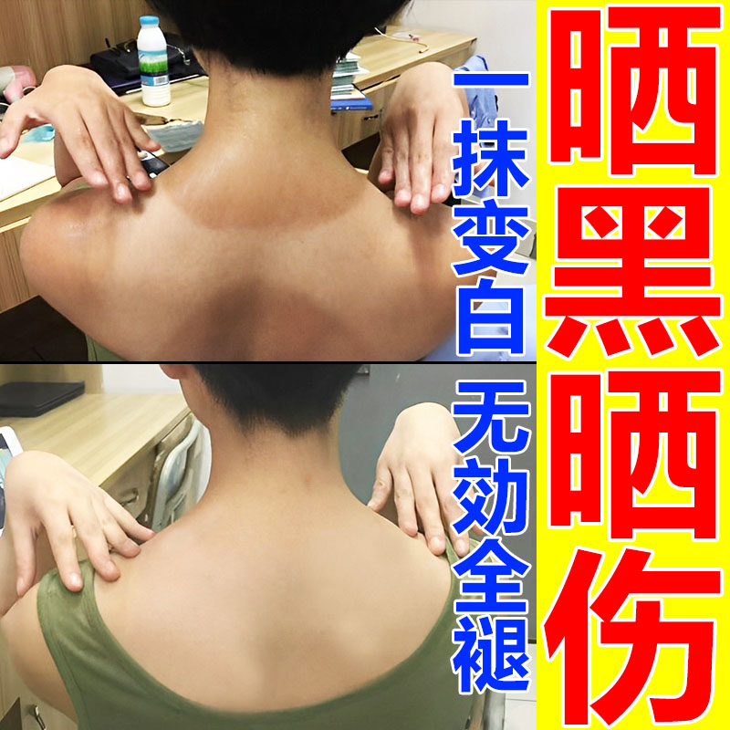 晒黑了皮肤晒伤晒后军训修复黑怎么快速变白霜儿童男士美白乳面部