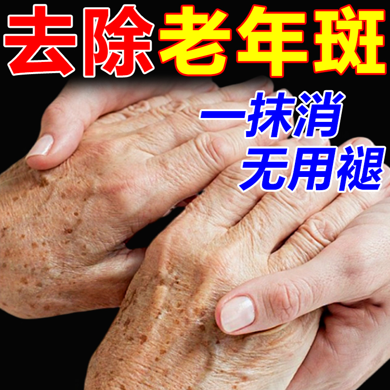 去老人斑专用药膏强力祛除老年黑班霜点黄褐斑除手部脸部的中药膏