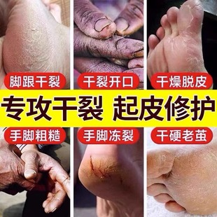 治手裂的药膏防干裂手脚上开裂脚后跟真菌感染手脱皮严重脱皮专用