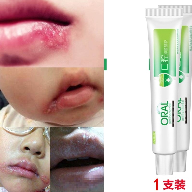嘴唇疮嘴上火起水泡嘴角起泡黏水疮羊胡疮口角痒烂上火起泡膏