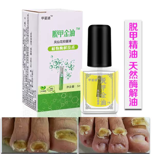 美康净去除酶解液脱甲液 脱甲精油软甲膏灰甲清指甲天然增厚|ruв категории Косметика, маникюрный инструмент - от Buy2taobao.com для оказания профессиональной услуги покупки агента Taobao