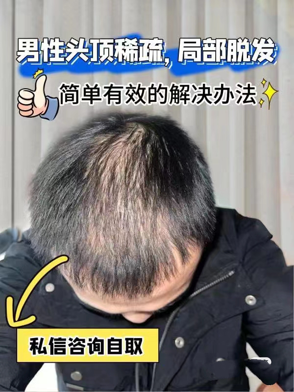 印度10年代购男女脱发问题 帮发友背货