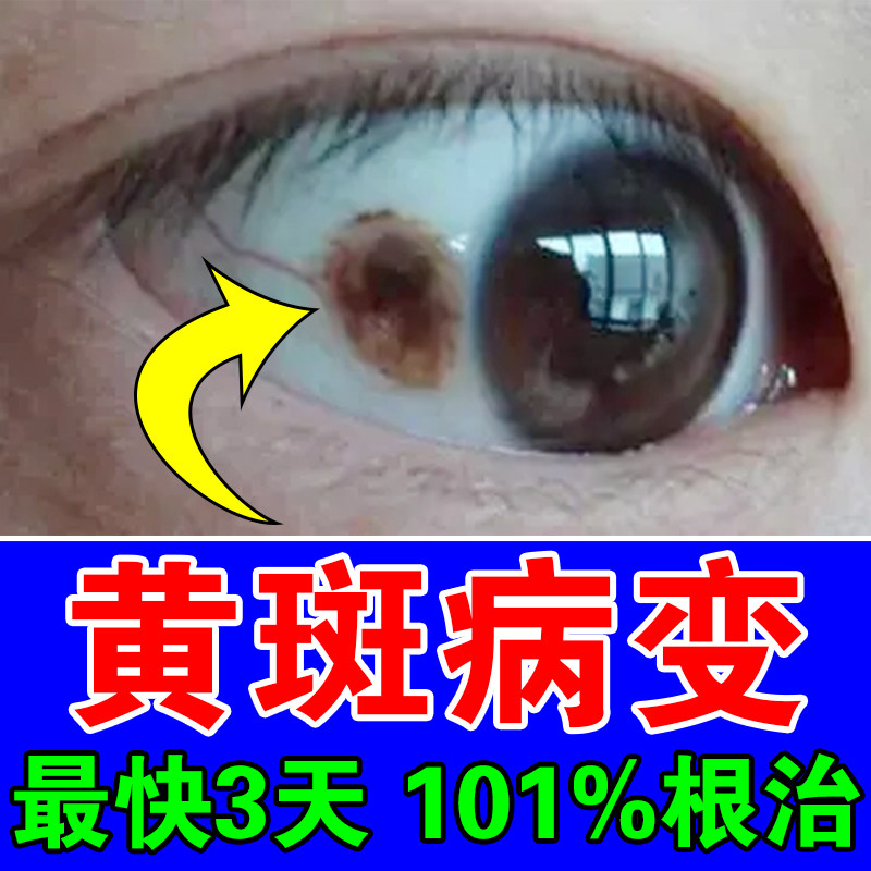 黄斑病变眼药眼睛干涩视力下降模糊改善眼白发黄变性眼底出血水肿