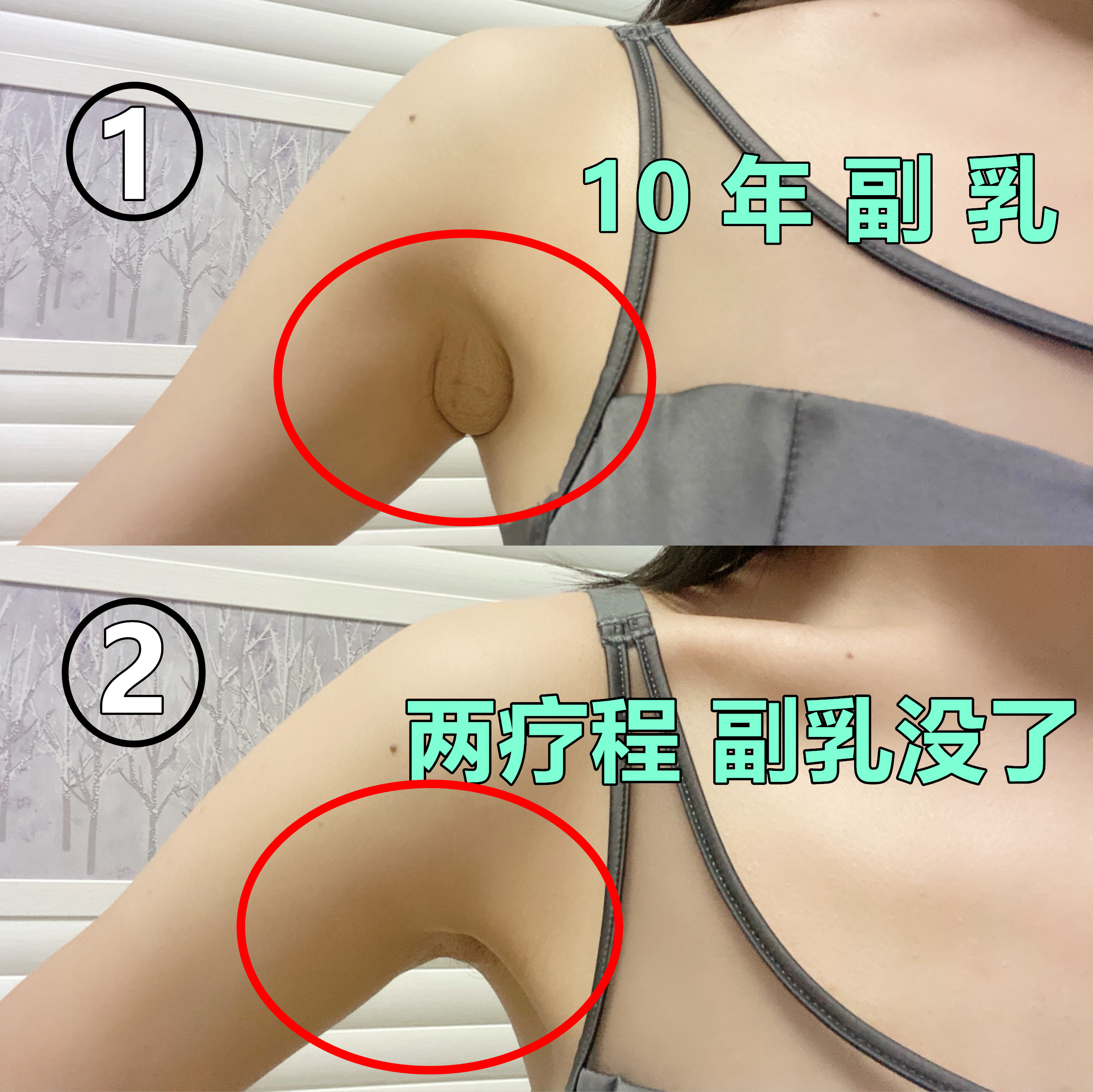 副乳上长乳头怎么办图片