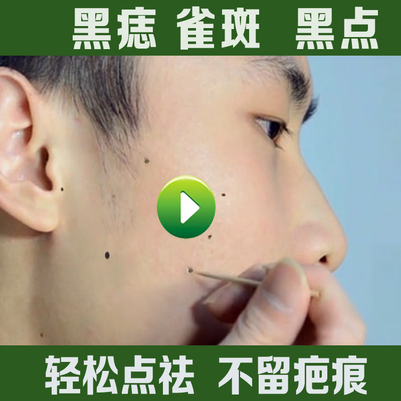 省5元 点痣膏无痕药水正品脸部祛痣祛斑痦子取痣贴去痣黑痣去除黑点