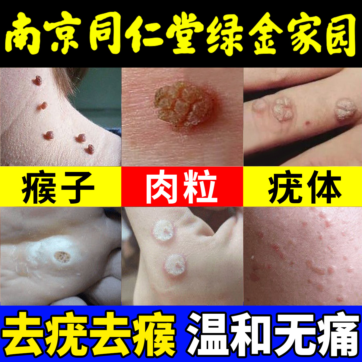 去猴子肉疙瘩瘊子专用药膏脖子上长小肉粒趾疣祛除神器一抹无忧根