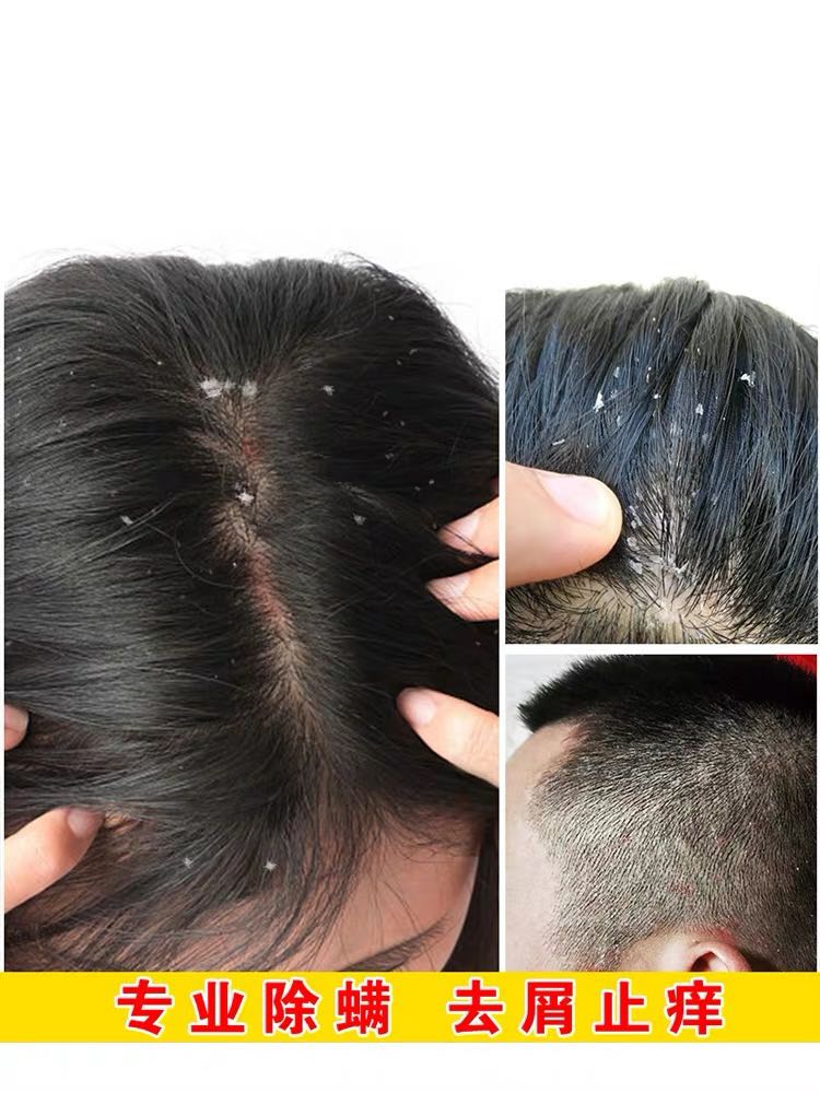 控油去屑止痒洗发水医药正品治头皮屑严重的药去螨虫头痒抗真菌女