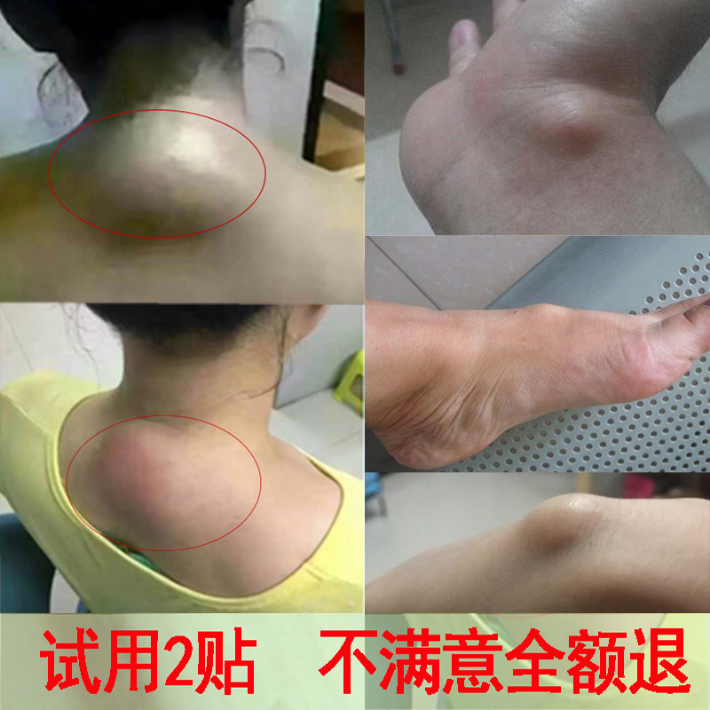 颈椎贴富贵包消除贴疏通大椎包贴膏颈部腱鞘舒筋贴大拇指关节痛贴
