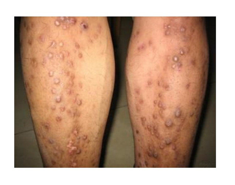 [ 结节平]疙瘩姜老太陈一修复堂止痒拔毒清湿化毒膏霜液80ml膏30g