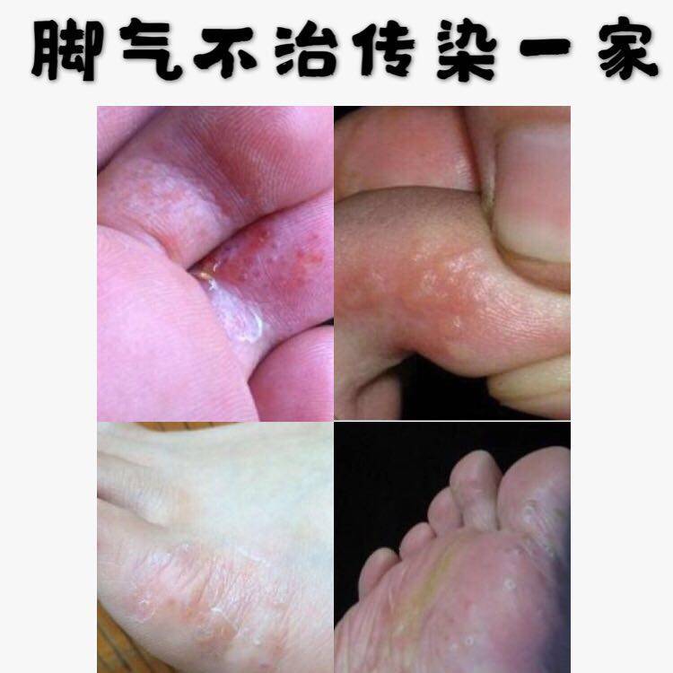 一折脚出汗脚臭_脚气喷剂止痒脱皮真菌水泡型脚臭粉痒膏泡脚烂脚丫