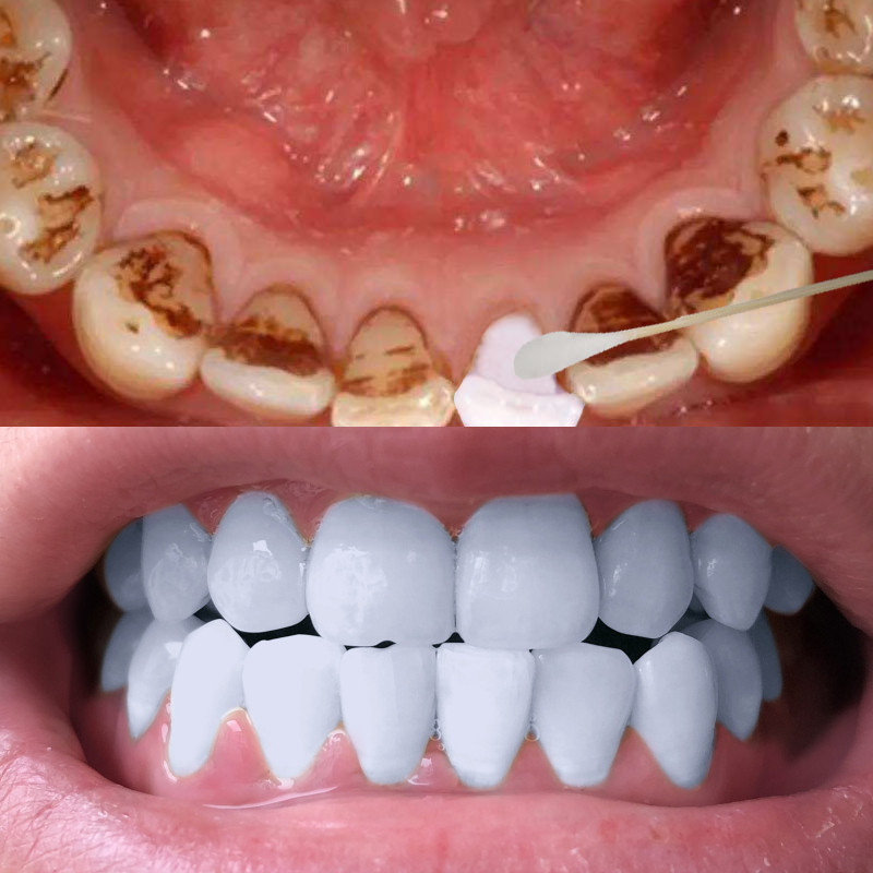 时通洗牙粉洁牙粉牙齿美白变白去黄牙烟牙渍结石黄黑烟洁牙素神器